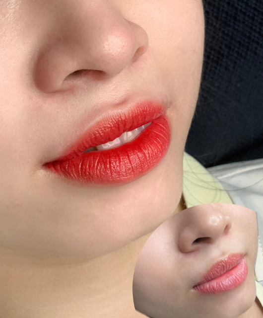 Xử Lý Môi Cũ 